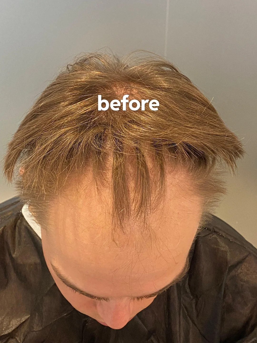 1-year-progress-2600-grafts-v0-e96op7uddrhf1.jpg