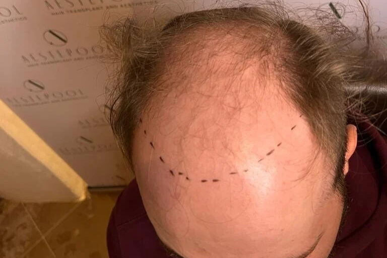 hair-transplant-daniel