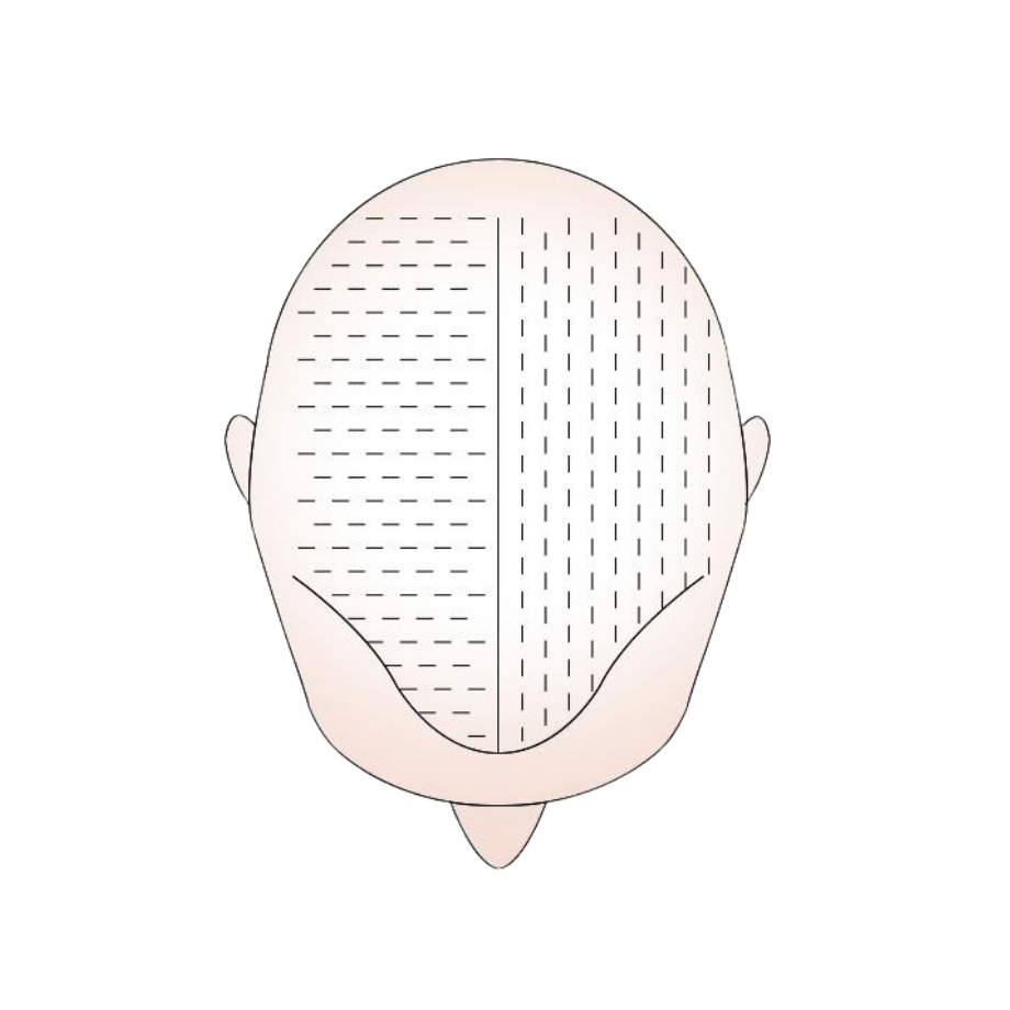 Micro FUE - Dr Ahtan Altan - Przeszczep włosów - Aestepool Clinic