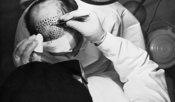 Historia transplantacji włosów Historia transplantacji włosów
