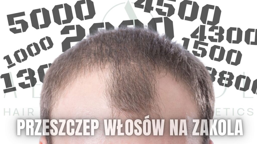 Przeszczep-wlosow-zakola przeszczep włosów zakola