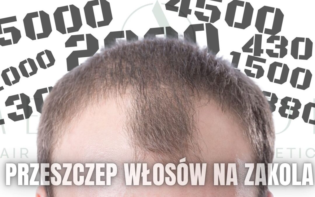 Przeszczep włosów na zakola