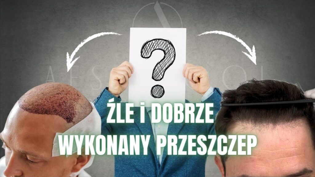 dobrze-wykonany-przeszczep dobry przeszczep włosów w Turcji