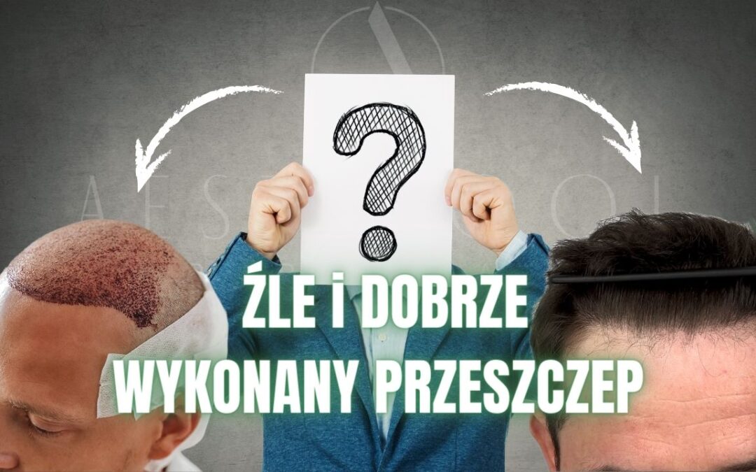 Dobrze wykonany przeszczep włosów